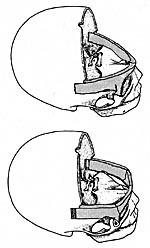  Figur 6    Illustrasjon av kraniet etter at en bifrontal beinlapp er fjernet. a) P&aring;tegnet er osteotomilinjene for&hellip;