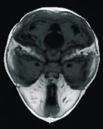  Figur 7    CT ansiktsskjelett med tredimensjonal rekonstruksjon som illustrerer den korte, spisse fremre skallegrop som man&hellip;