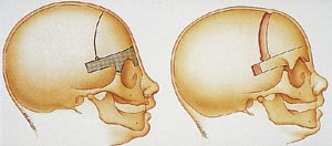  Figur 1    Illustrasjon av kraniet etter et frontoorbitalt avansement. Alle illustrasjonene fra brosjyre, MID System,&hellip;