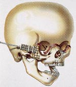  Figur 2    Illustrasjon av kraniet etter en Le Fort III-osteotomi og p&aring;setting av distraksjonsapparat