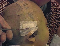  Figur 5    Aktiveringskabel til internt distraksjonsapparat f&oslash;res ut bak &oslash;ret. Distraksjonsapparatet aktiveres ved &aring; rotere&hellip;