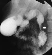  Figur 2    R&oslash;ntgenunders&oslash;kelse av ventrikkel og duodenum (sidebildet). Stenose i nedadstigende del av duodenum (pil)