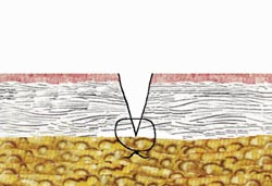  Figur 13    Subdermal sutur i djupa dermis