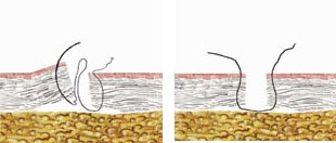 Figur 16 a, b    D&aring; suturen satts genom ena s&aring;rkanten tas n&aring;len upp och s&auml;tts om p&aring; n&aring;lf&ouml;raren f&ouml;r att m&ouml;jligg&ouml;ra ett&hellip;