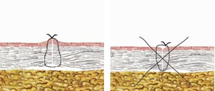  Figur 17 a, b    S&aring;rkanterna skall vara everterade, dvs st&aring; upp som en &aring;s, d&aring; suturen knutits, och inte inverterade &hellip;