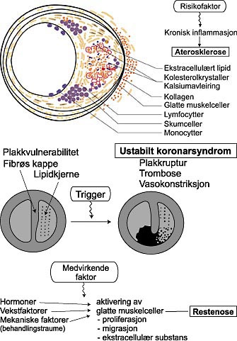 Figur 2  Skjematiske illustrasjoner av ulike prosesser ved koronar hjertesykdom. Infeksjon kan v&aelig;re medvirkende i disse&hellip;
