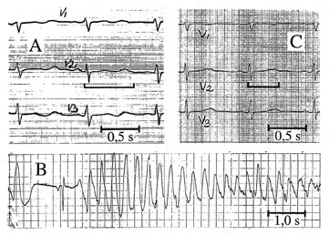  Figur 1    EKG-registreringer av den pasienten som presenteres i kasuistikken, se ramme. A. EKG under sinusrytme ved&hellip;