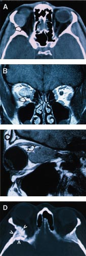  Figur 3    Eksempler p&aring; svulster i orbita visualisert ved hjelp av CT eller MR. CT-unders&oslash;kelse (aksial snittf&oslash;ring) av&hellip;
