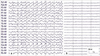  Figur 2    Pasient 2.  a) EEG under ikke-konvulsiv status epilepticus, omtrent to timer etter symptomdebut, viser rytmisk&hellip;