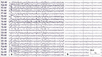  Figur 3    Pasient 3.  a) EEG under ikke-konvulsiv status epilepticus viser kontinuerlig anfallsaktivitet i form av&hellip;