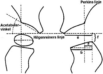  Figur 2    Skjematisk fremstilling av normalt r&oslash;ntgenbilde av bekkenet hos et ca. 5 m&aring;neder gammelt barn. I h&oslash;yre hofte er&hellip;