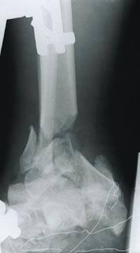  Figur 1    Sidebilde av venstre ankel i akuttstadiet. Bildet er utl&aring;nt fra R&oslash;ntgenavdelingen, Regionsykehuset i Trondheim