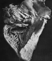 Foto av hjertet. Illustrasjon fra artikkelen til F. Harbitz i 1930 (1)