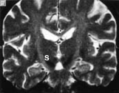  Figur 2    Frontalt snit, som demonstrerer m&aring;lorganet, i dette tilf&aelig;lde nucleus subthalamicus (S)