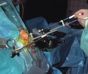  Figur 3    Den operative opstilling ved implantation af elektroder i nucleus subthalamicus. Stereotaksirammen er skruet p&aring;&hellip;