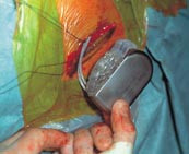  Figur 5    Pulsgenerator (IPG), som placeres under huden p&aring; forsiden af brystkassen