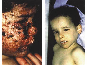  Figur 3    a) Pasienter med xeroderma pigmentosum og  b) trichothiodystrofi. Legg merke til den store fenotypiske&hellip;