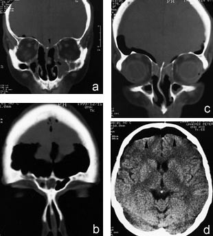  Figur 2 a &ndash; d)    Postoperativt ble det utf&oslash;rt ny CT-unders&oslash;kelse. a &ndash; c) bihuler, koronale 5/10 mm, koronare snitt og d)&hellip;