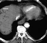  Figur 2    Luftportogram. Luft forgrener seg helt ut til kapselen