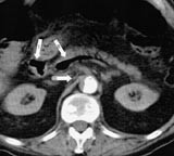  Figur 3    Luft i konfluens v. portae (I), v. lienalis (II) og veggfast trombe i aorta (III)