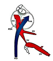  Figur 3    Sagittalt snitt viser hvordan blodstr&oslash;mmen fra ductus venosus (DV) n&aring;r venstre atrium (VA) uten f&oslash;rst &aring; g&aring;&hellip;