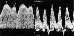  Figur 4    Normal blodstr&oslash;m i ductus venosus (til venstre) har h&oslash;y hastighet og gjenspeiler systolen (s), passiv diastolisk&hellip;