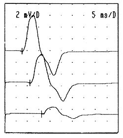  Figur 2    Pasient 2. Motorisk nevrografi av h&oslash;yre n. ulnaris, registrert fra hypothenar, stimulert p&aring; hhv. (ovenfra og ned&hellip;