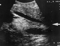  Figur 3    Distale (intrapankreatiske) del av ductus choledochus mot papillen