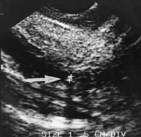  Figur 5    2 mm konkrement distalt i ductus choledochus