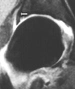 Figur 2  MR-artrogram med koronal gradientekko T1-vektet fettsuppresjonssekvens viser normal labrum (pil), og&hellip;