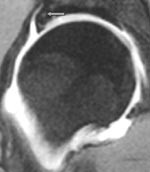 Figur 3  MR-artrogram med koronal gradientekko T1-vektet fettsuppresjonssekvens viser h&oslash;ysignalomr&aring;der i labrum (pil) med&hellip;