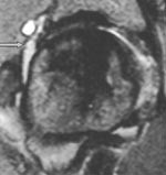 Figur 5  MR-artrogram med koronal short T1 recovery-sekvens viser superolateral ganglion, forenlig med stadium 2A&hellip;