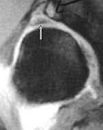 Figur 6  MR-artrogram med koronal gradientekko T1-vektet fettsuppresjonssekvens viser avrevet labrum fra acetabulum,&hellip;