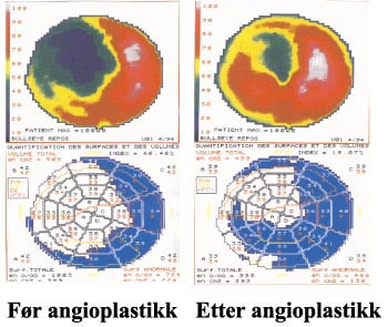 Figur 3  Perfusjonsscintigram av venstre ventrikkel i polar fremstilling f&oslash;r og seks uker etter vellykket angioplastikk av&hellip;