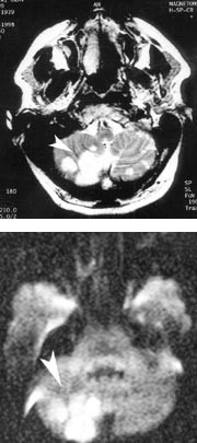Figur 2  MT hode.  a) Multiple infarkter i cerebellum, mest uttalt p&aring; h&oslash;yre side (pil). b) Diffusjonsvektet bilde viser at&hellip;