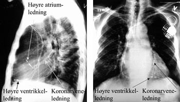 Figur 2  R&oslash;ntgen thorax av pasient 3 med atriobiventrikul&aelig;rt pacemakersystem med en ledning i h&oslash;yre atriums aurikkel, en&hellip;