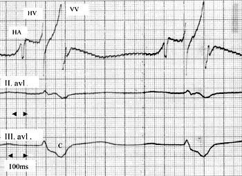 Figur 3  Avledning av elektrogram endokardialt fra h&oslash;yre ventrikkel og epikardialt fra venstre ventrikkel hos pasient 3&hellip;