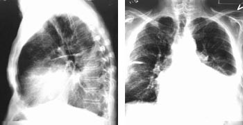 Figur 4  R&oslash;ntgen thorax av pasient 1 f&oslash;r implantasjon av biventrikul&aelig;r pacemaker. Bildet viser stort hjerte, betydelig&hellip;