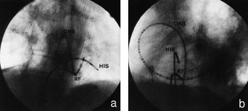 Figur 2  Fluoroskopisk bilde (a) 30˚ h&oslash;yre fremre skr&aring;projeksjon, b) 45˚ venstre fremre skr&aring;projeksjon). ORB = OrbiterTM&hellip;