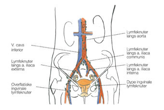 Figur 2  De prim&aelig;re lymfeknutestasjoner ved gynekologiske kreftformer: langs kar i lyskene, i bekkenet og langs aorta
