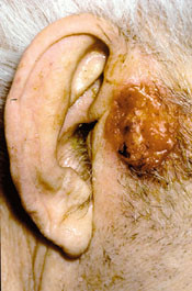 Figur 5  Nodul&auml;rt besaliom