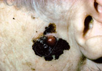 Figur 8  Lentigo maligna