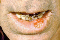 Figur 9  Skivepitelcancer