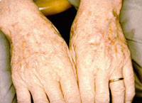 Figur 10  Aktinisk keratos