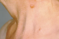 Figur 13  Hudmetastas, pankreascancer