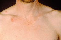 Figur 14  Hudmetastas, ventrikelcancer