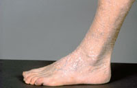 Figur 15  Stuckkeratos