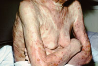 Figur 16  Mycosis fungoides