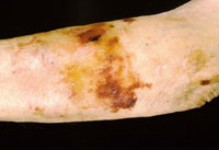 Figur 17  Stj&auml;rnformade &auml;rr