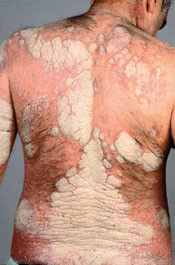 Figur 20  Psoriasis